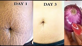 Get Rid Of Stretch Marks Super fast and Permanently, Have a Nourished Smooth Soft Body screenshot 4