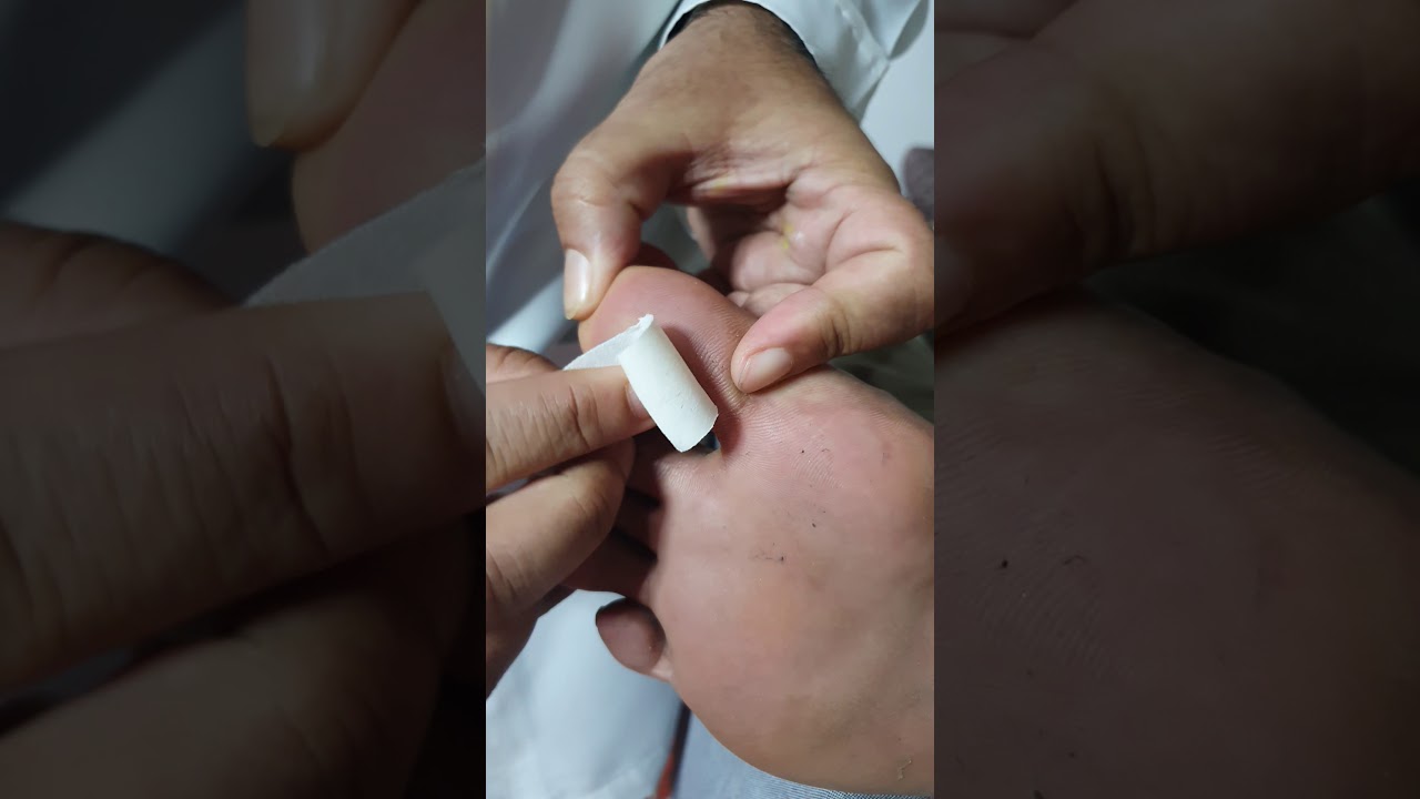 How to use Corncap at home for the treatment of Corn