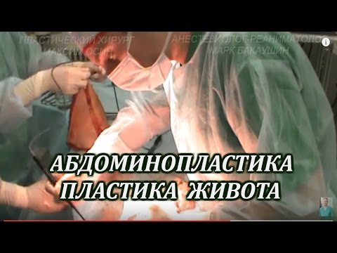 Абдоминопластика.Пластический хирург Максим Осин.Общая анестезия Марк Бакаушин анестезиолог