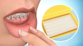 Ortodontik mum kullanımı Resimi