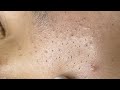 Satisfying Relaxing with Sac Dep Spa Video (#087) #acne