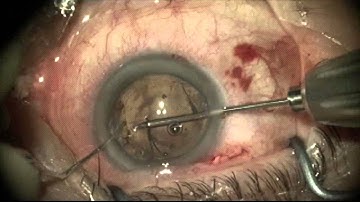 Crystalens Z syndrome: IOL exchange by Steven G. Safran MD