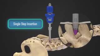 Superion Indirect Decompression System