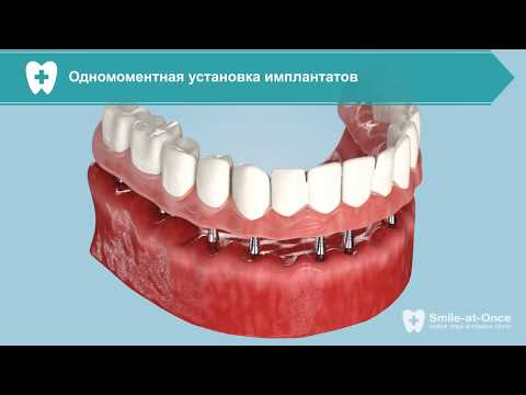 Лечение пародонтоза при помощи имплантации за 3 дня