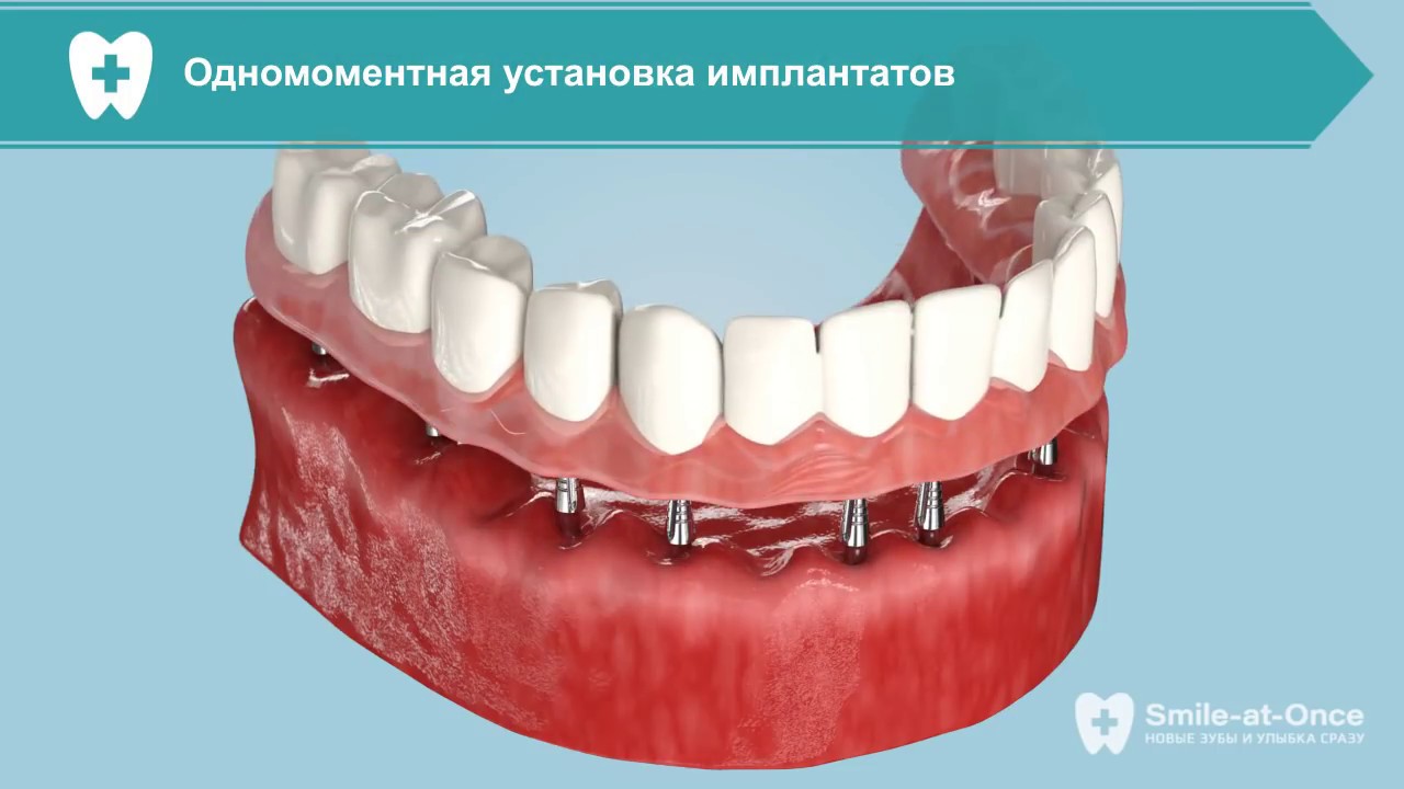 Лечение пародонтоза при помощи имплантации за 3 дня - YouTube