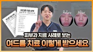 [실제 치료 사례✨] 여드름 치료! 피부과에서 이렇게 받으세요! #시술전후 #실리프팅 #레이저리프팅 #통증