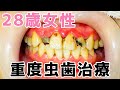 【28歳女性】虫歯治療編🦷ボロボロの前歯が驚きの変化✨😄