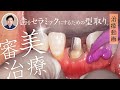 札幌市の歯医者「ユアーズデンタル クリニック」　審美歯科治療セラミック歯型採り　左上2除去