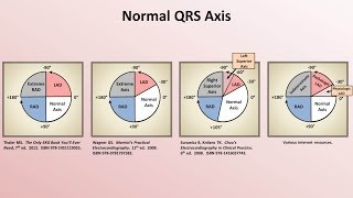 Intro to EKG Interpretation  Rate and Axis