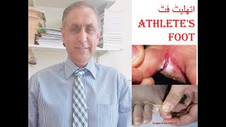 Athlete's foot!How to cure Athlete's foot!Athlete's foot cream