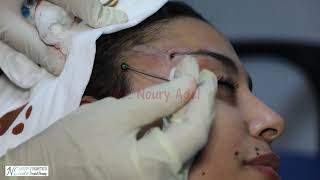 Fox eye thread lift رفع الحاجب (عين الثعلب - عين القطة) - Dr. Noury Adel