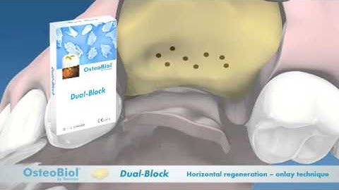OsteoBiol® Dual-Block