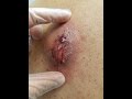 Graphic massive back abscess drainage step by step medical education  training