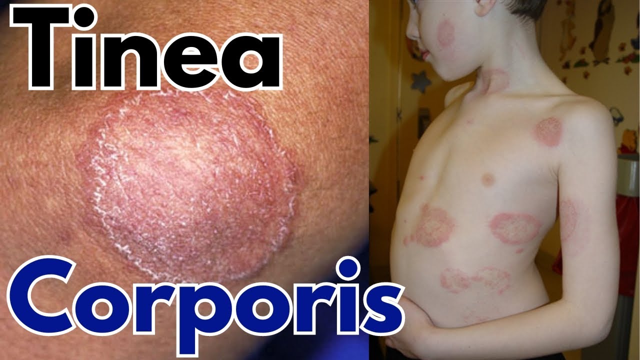 Tinea corporis infection  Ring worm symptoms, treatment and