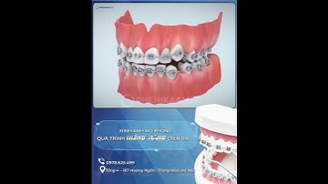 NIỀNG RĂNG MẮC CÀI - 