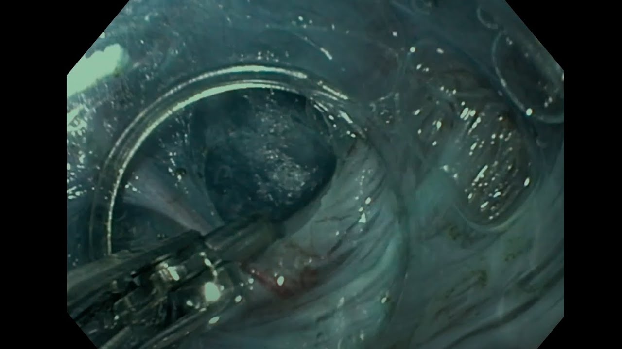 egj-outflow-obstruction-poem-youtube