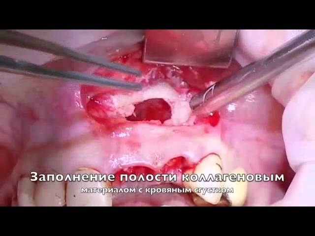 Удаление радикулярной кисты верхней челюсти. Часть 2