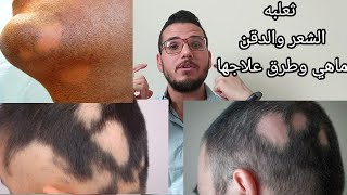 الثعلبه فراغات الشعر ماهي وطرق علاجها