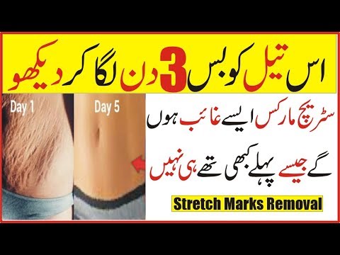 stretch-marks-removal-at-home-in-urdu-|-get-rid-of-stretch-marks-permanently-urdu-hindi