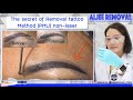 Eyebrows Tattoo Removal can make new eyebrows immediately on the same day : Non-Laser