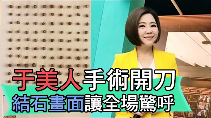 【精華版】于美人手術開刀 結石畫面讓全場驚呼 - 天天要聞