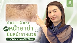 รักษาฝ้า I EP.12 ฝ้าฮอร์โมน รักษาหายได้ ด้วยเคล็ดลับของคลินิกเรา  l The Vive Clinic