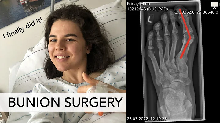 BUNION SURGERY I Would I do it again? Let's talk about: pain, scars, recovery ... - DayDayNews