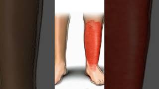 " Understanding Cellulitis: Causes, Symptoms."