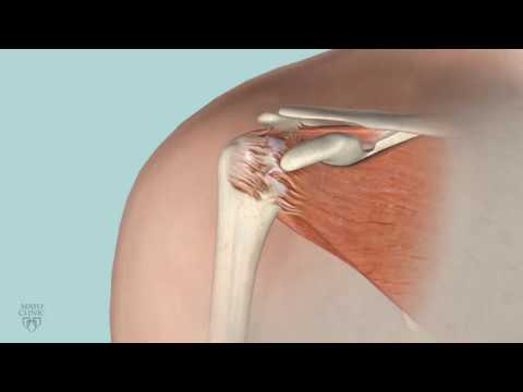 Rotator Cuff Repair with Arthrex® SutureBridge™