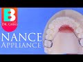 Nance Appliance during Braces