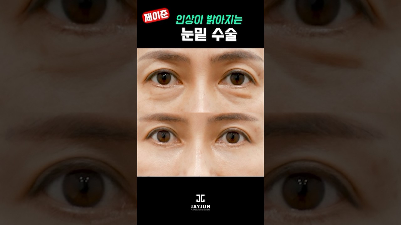 [Thẩm mỹ viện Jayjun] Tạo khuôn mặt trẻ trung | Trũng mắt dưới | Quầng thâm | Chảy xệ mắt dưới