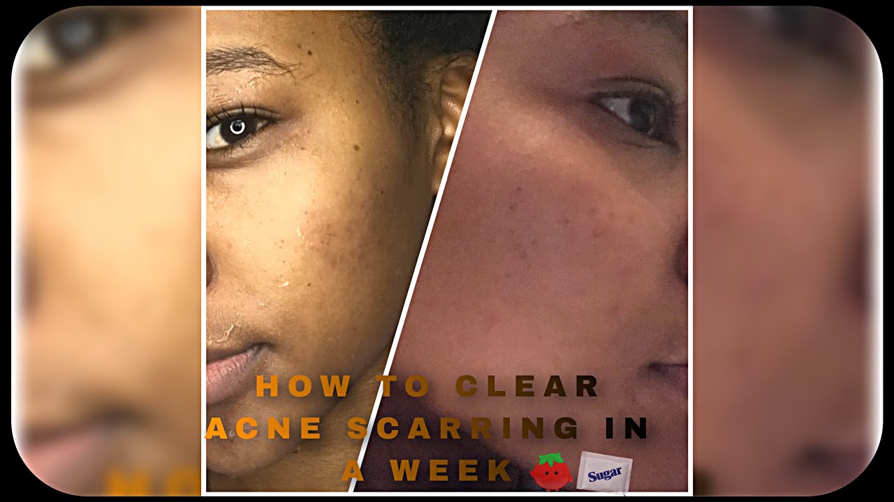 I GOT TESTED FOR COVID 19😭😭//HOW TO CLEAR ACNE SCARRING IN A WEEK