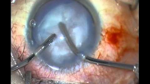 Argentina flag sign. Difficult phacoemulsification.