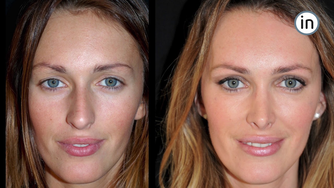 Antes e Depois - Rinoplastia - YouTube