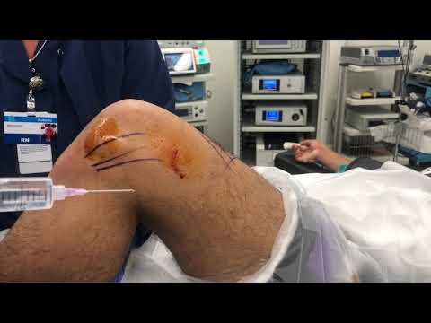 Local Anesthesia for Knee Arthroscopy: How I do it
