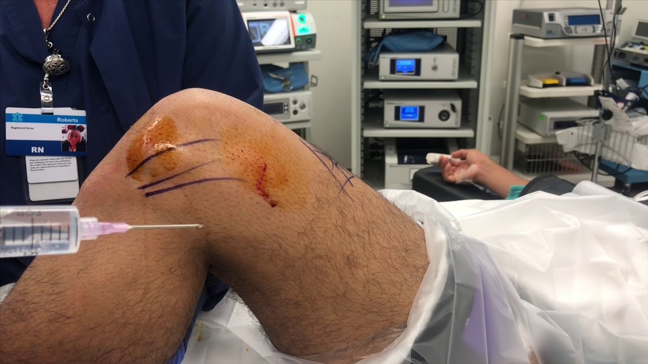 Local Anesthesia for Knee Arthroscopy: How I do it