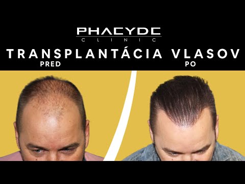 Video: Môžu Sa Orgány Ošípaných Transplantovať Do ľudí? Je čas To Zistiť - Alternatívny Pohľad