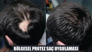 Bölgesel Protez Saç Uygulaması