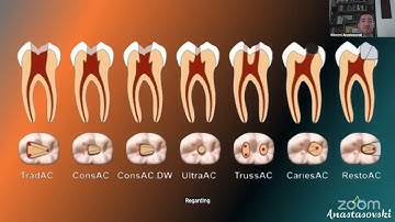 Top-notch Root Canal Shaping and Obturation
