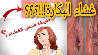 غشاء البكرة.فين كاينة وشنو لي كيمزقها و الانواع ديالها.و معلومات اخرى