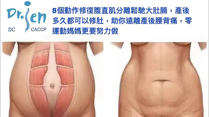 5個動作修復腹直肌分離鬆馳大肚腩，產後多久都可以修肚，助你遠離產後腰背痛，零運動媽媽更要努力做 5 moves help to correct Postpartum Diastasis Recti - 天天要聞