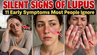 Lupus Starts Silently… 11 Symptoms Of Lupus (Don't Ignore)