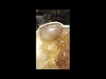 Adult Head (Hematoma) 30ml