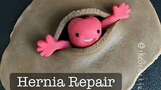 Playdough Surgery 🔪🗣- Open Inguinal Hernia Repair (Lichtenstein tension-free mesh repair)