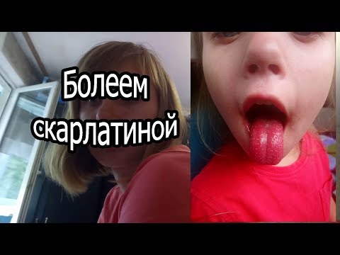 Вопрос: Как распознать и вылечить скарлатину?