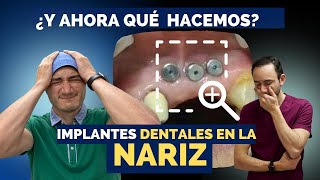 ¿Y ahora qué  hacemos? ¡Implantes dentales en su nariz!