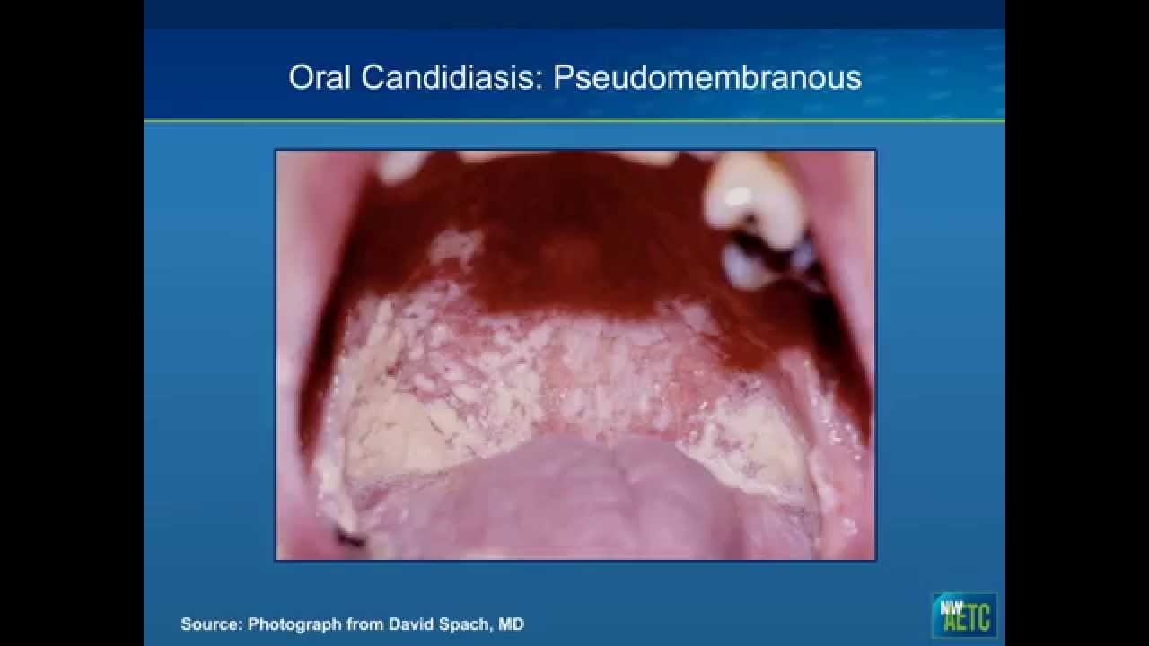 hiv symptoms on lips