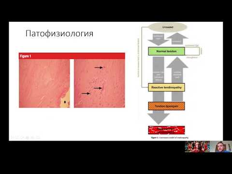 Видео: Причини и лечение на квадрицепс тендонит (тендинопатия)