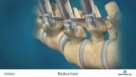 Minimally Invasive Spinal Fixation