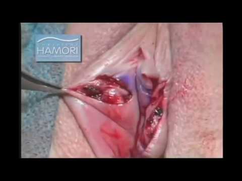 Wedge labioplasti animasyon videosu